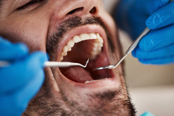 Dental Inlays and Onlays in Lowell, IN